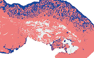 免疫染色胃癌肿瘤切片的定量