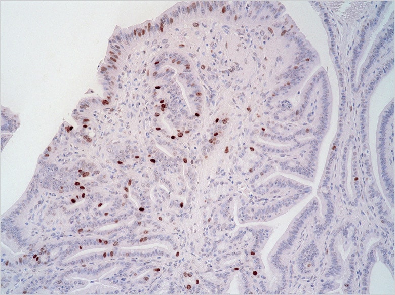 图片:癌细胞在胃组织中增殖